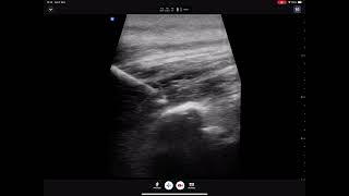 ESP block at T5 for intercostal neuralgia [upl. by Ahserak]