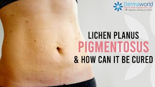 How to cure Lichen Planus Pigmentosus  Lichen Planus Pigmentosus Treatment  Dr Rohit Batra [upl. by Htebsle650]