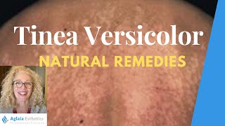 NATURAL HOME REMEDIES FOR TINEA VERSICOLOR [upl. by Pros]