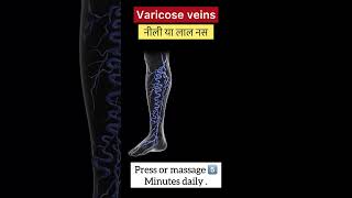 Varicose veins [upl. by Inaleon]