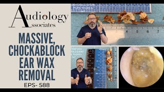 MASSIVE CHOCKABLOCK EAR WAX REMOVAL  EP588 [upl. by Lyns]