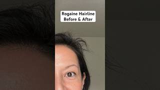 Rogaine Foam Hairline Before And After 💁🏻‍♀️ Minoxidil For Women [upl. by Charpentier642]