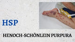 HenochSchönlein Purpura HSP [upl. by Ginelle]