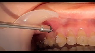 Mini screw mini implant insertion  screwing in orthodontic miniimplant TAD [upl. by Annodam]