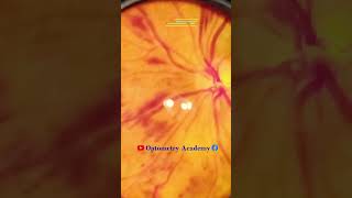 Diabetic retinopathy  Hemorrhages  proliferative diabetic retinopathy PDR  Short Video 182 [upl. by Diamond]