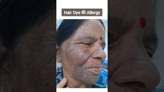 Lichen Planus Pigmentosus  चेहरे पर कालापन  hair dye allergy Face Pigmentation hairdye tanning [upl. by Neesay]