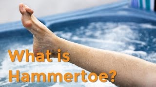 To Your Health Quick Takes What is Hammertoe [upl. by Col715]