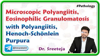 3 Microscopic Polyangiitis Eosinophilic Granulomatosis with Polyangiitis HenochSchönlein Purpura [upl. by Salomie]