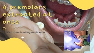 BRACES UPDATE EXTRACTIONS I got 4 TEETH REMOVED in 2 minutes while wide awake overbite correction [upl. by Vachil]