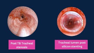 Post TB TracheoBronchial stenosis Repair [upl. by Faustena]