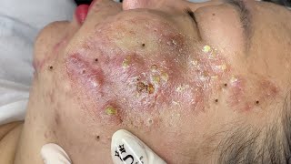 Big Cystic Acne Blackheads Extraction Blackheads amp Milia Whiteheads Removal Pimple Popping  65765 [upl. by Yecac]