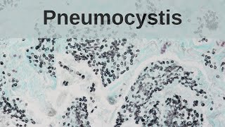 Pneumocystis Pneumonia  Pathology mini tutorial [upl. by Ahsirpac]