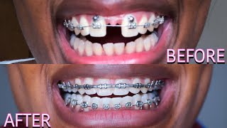 Full Braces Journey Time Lapse  3 Years Gaps Overbite Frenectomy  Starring Shameka [upl. by Boiney396]