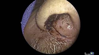 Nasal Myiasis or Sinus Maggots PART 2 [upl. by Stern]