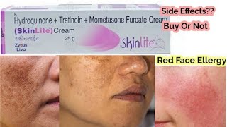 Hydroquinone Tretinoin Mometasone Furoate cream Honest Review l Benefits l Side Effects ll [upl. by Aerbas]