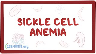 Sickle cell anemia  causes symptoms diagnosis treatment amp pathology [upl. by Imar]