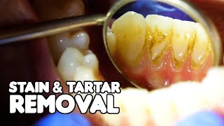 Dental Cleaning EXPLAINED  Stain amp Tartar Removal [upl. by Edasalof]