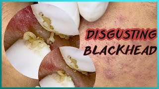 Big Cystic Acne Blackheads Extraction Blackheads amp Milia Whiteheads Removal Pimple Popping [upl. by Ramas]