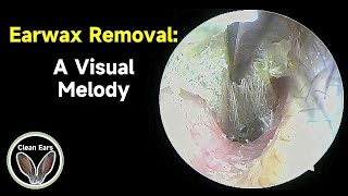 Cerumen Removal A Visual Melody [upl. by Yllatan193]