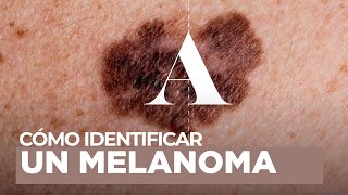 Melanoma qué es y cómo identificarlo [upl. by Hallette703]