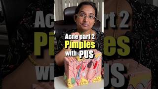 How To Treat Pus Filled Acne At Home  Papules amp Pustules trending [upl. by Mchale]