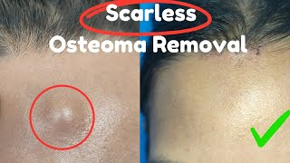 Scarless Osteoma Removal Bony swelling removal from forehead Best osteoma Removal [upl. by Llyrat]