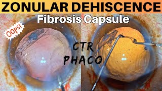 Zonular Dehiscence Noted during Phacoemulsification Management strategies  Dr Deepak Megur [upl. by Lanta]