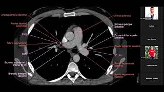 Tomografía de torax  Anatomía [upl. by Ahsenad]