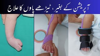 Club foot physiotherapy treatment  ExercisesTapingSplint ٹیڑھے پاوں کا علاج stretching physio [upl. by Neelrak389]