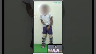 child with cerebral palsy started walking with activityoriented therapy at Trishla shorts [upl. by Krasnoff]