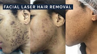 How to get rid of Ingrown hairs with Laser Hair Removal [upl. by Savadove336]