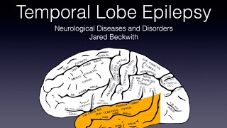 Temporal Lobe Epilepsy 🧠⚡️ [upl. by Timrek]