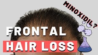 Frontal Hair Loss  Does Minoxidil Work [upl. by Annij]