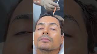 Trichometric PRP Hair Treatment to Deal With Hair Loss [upl. by Ahsaetal662]