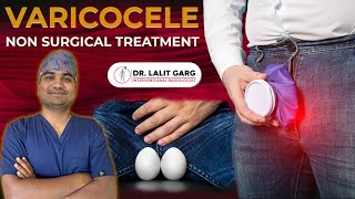 Varicocele Embolization By Dr Lalit Garg Nonsurgical Treatment For Varicocele [upl. by Rabah]