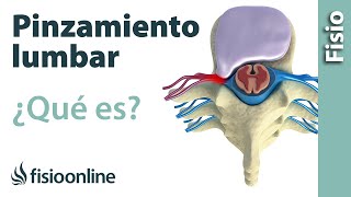 Pinzamiento lumbar  ¿Qué es [upl. by Nadeen748]