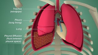 Pleural effusion  Internal medicine Etiology Clinical Features Diagnosis and Treatment Usmle [upl. by Dduj]