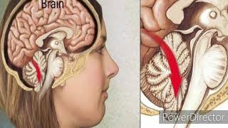 Brain Herniation or Herniation Syndrome [upl. by Ferrel]