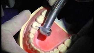 Moez Khakiani Molar Crown Preparation PFM [upl. by Naneik]