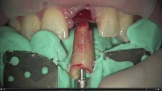 Dental Excellence 17 Root Extraction System [upl. by Netaf919]