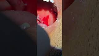 Quinsy Peritonsillar abscess incision and drainage  Dr Hitesh Patel [upl. by Cerallua]