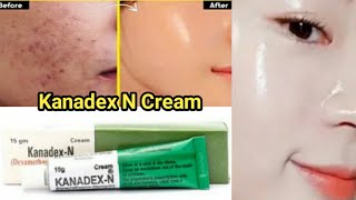 Kanadex N Cream Review  Freckles Removal Treatment  Kanadex n cream purpose  Use  Side effects [upl. by Funk]