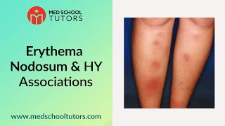 Erythema Nodosum amp High Yield Associations for the USMLE Step 1 [upl. by Kcajyllib]