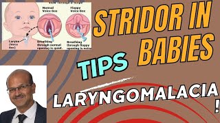 Approach to infants with stridor Laryngomalacia noisy breathing noisybreathing babybreathing [upl. by Fougere]