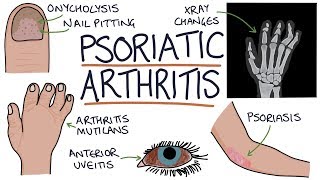 Psoriatic Arthritis [upl. by Elenaj]