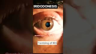 IRIDODONESIS Trembling of IRIS eyetuberoptomeyehealtheyecareshorts [upl. by Davis]