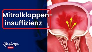 Mitralklappeninsuffizienz  einfach erklärt  DrHeart [upl. by Lari20]