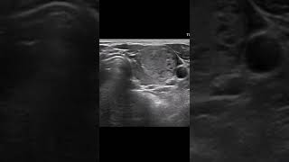 Graves Disease amp Thyroid Nodule Dx Papillary cancer cases ultrasound thyroid [upl. by Aiek]