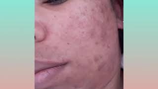 Tratamento para manchas de acne com SUAVICID ANTES X DURANTE [upl. by Earleen]