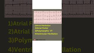 ECG diagnosis  ECG Analysis  ecg reading ecg ecginterpretation ventriculartachycardia vf svt [upl. by Alel]